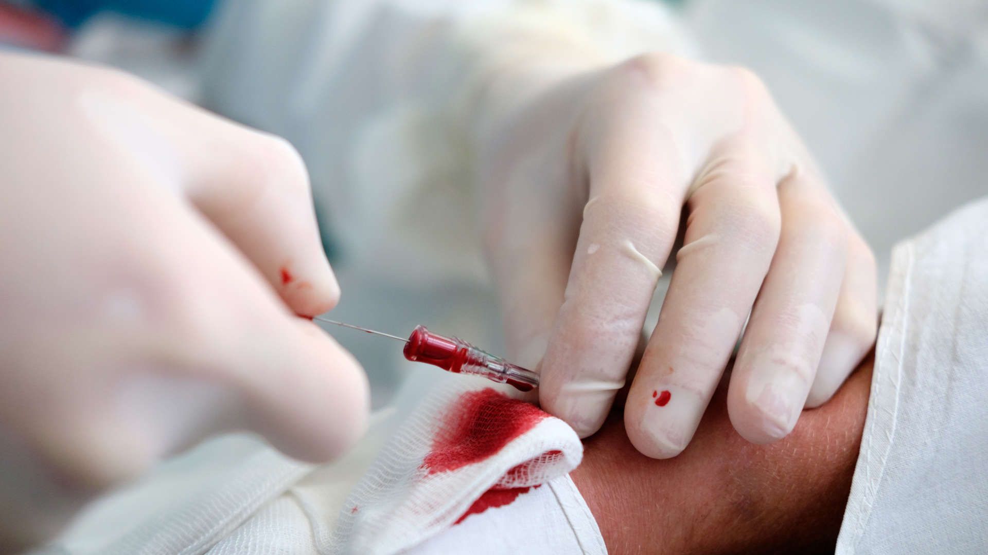 Arterial catheter being placed